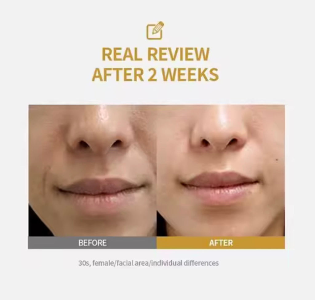 SkinLift™